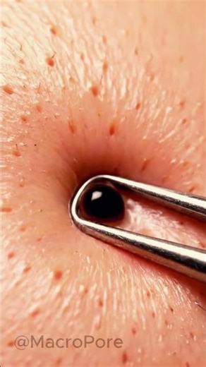 Ultra-Realistic Comedone Extraction | 4K Macro Pore ASMR (Clean Clinical View)