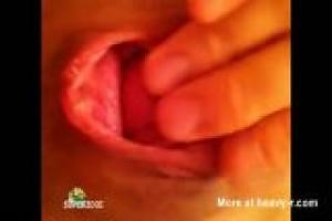 Prolapse Pooping Close Up