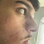 Blackhead Remover Pore Vacuum Upgraded Facial Pore