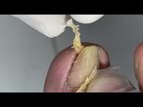 Curved nail repair - Nail Skill Teaching by Mr toenail