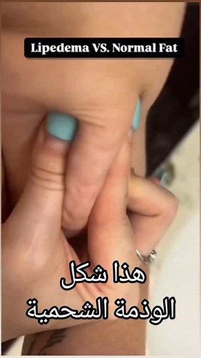 ماهو النسيج الدهني Adipose tissue ? هو مو فقط ينطي جمالية للملابس او مرتبط بالانوثة لا النسيج الدهني شي اكبر من هيج ! Adipose tissue as an endocrine organ هو من اكبر اجهزة الغدد الصماء النسيج الدهني عنده وظائف ويفرز هرمونات ! هرمونات تتحكم بالشهية هرمونات تتحكم بالايض ومقاومة الانسولين ! النسيج الدهني اذا زاد عن نسبته الطبيعية% رح يلتهب بسبب تراكم الخلايا الدهنية رح تموت بعض الخلايا الدهنية وتحفز التهاب مزمن وتجذب الخلايا المناعية macrophages التهاب مزمن >>>> بناء تليفات Adipose tissue fibrosis 