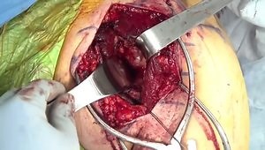 Open Latarjet Procedure for Recurrent Anterior Shoulder Instability with Glenoid Bone Loss: Technical Considerations