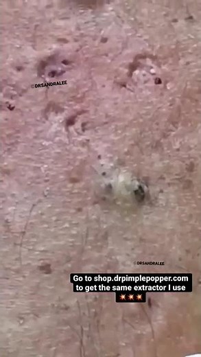 Satisfying Blackhead Extractions w Dr Pimple Popper! 💥 #shorts
