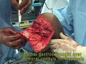 Knee Disarticulation Amputation - Total