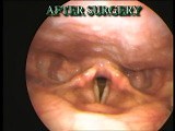 Endoscopic View Before & After Surgery-Vocal Fold Polyp Part II • Video • MEDtube.net