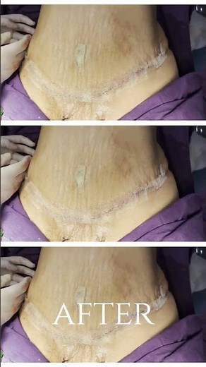 Tummy Tuck Treatment: Transform Your Abdomen in No Time!