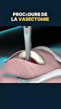 La procédure de la vasectomie