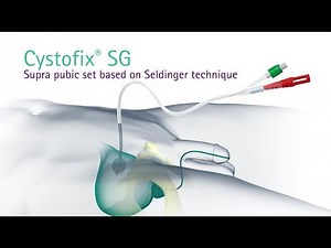 Cystofix® SG for Suprapubic Catheterization