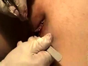 Female circumcision - MODCON