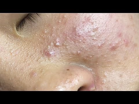 Removing Multiple Blackheads on the Face | Deep Facial Cleansing at Spa Linh Mun #12