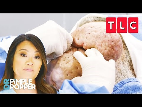 Dr. Lee Treats The Largest Nasal Growths She's Ever Seen | Dr. Pimple Popper | TLC