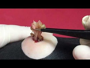 BEST Pimple Popping // Big Cystic Acne Blackheads // Whiteheads Removal / Squeezing Pimples / H#053