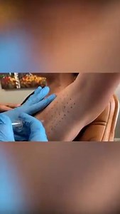 2.1K views · 18 reactions | Botox works by blocking the nerves...