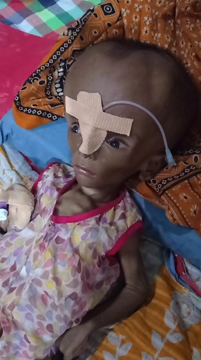 Hydrocephalus baby God bless him #hospital #hydrocephalus | Medical practice