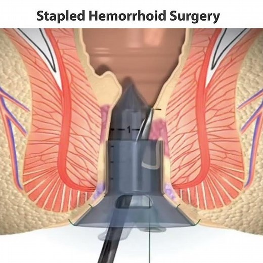 Stapled Hemorrhoids Surgery | Jyoti Nursing Home | Best Piles Hospital In Jaipur |