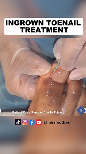 3.5K views · 18 reactions | Stubborn Ingrown Toenail Treatment | Miss Foot Fixer | Marion Yau #ingrowntoenailremoval #toenailremoval #missfootfixer #toenailfungustreatment #toenail | Miss Foot Fixer | Facebook