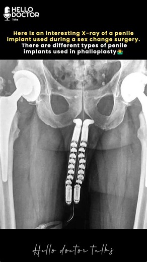 Here is an interesting X-ray showing a penile implant placed during a sex reassignment surgery.