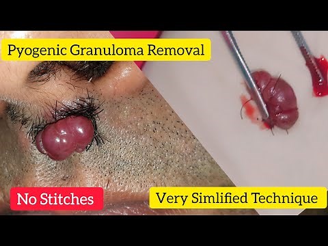 Pyogenic Granuloma Removal - Dr. Anuj Pall MD, PhD, FISD (USA)