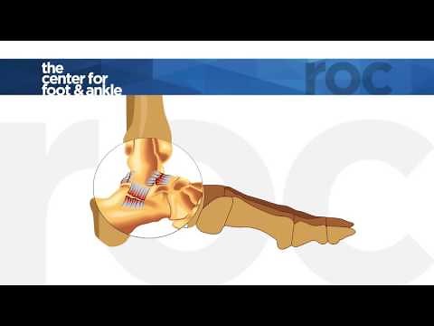ROC Sprain vs Strain