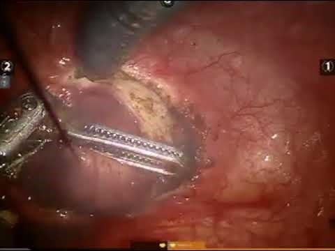Robotic assisted laparoscopic suprapubic simple prostatectomy step-by-step approach