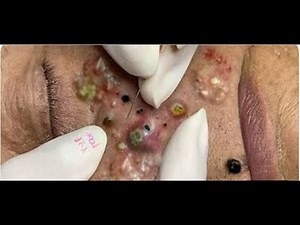 Blackhead Removal on Chin — Full Cleaning Guide