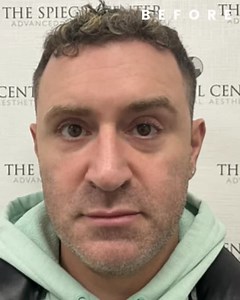 POV: Your under-eyes finally match how rested you wish you felt 😌✨⁣ This before and after is a perfect example of how subtle filler can make a major difference. No more hollowness, no more shadowing—just brighter, smoother eyes that still look like you. 👏⁣ ⁣ Under-eye filler is one of my favorite treatments because it gives such natural, refreshed results without looking overdone. ⁣ ⁣ 📍Performed with precision 💉 Hyaluronic acid-based filler ⏰ Minimal downtime, lasting results ⁣ Ready to stop