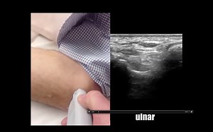 Ultrasound Guided Ulnar Nerve Block