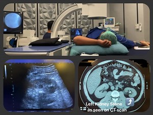 ESWL or more popularly known as SHOCKWAVE Lithotripsy is one of the interventions for small kidney, ureteral and urinary bladder stones. Shock wave lithotripsy is a technique for treating stones in the kidney and ureter that does not require surgery. Instead, high energy shock waves are passed and targeted through the body and used to break and fragment stones into pieces as small as grains of sand. Because of their small size, these pieces can pass from the body along with the urine. The proced