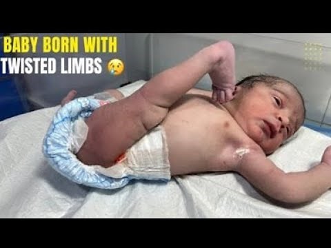 🦴 Real Medical Case: Dislocated Hip Explained & Treated | Neonatal Orthopedic Care 🩺