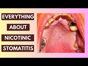 Nicotinic Stomatitis Explained: Causes, Symptoms, and Treatment Options | In-Depth Lecture