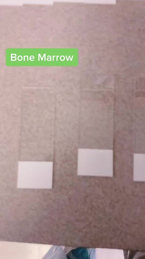 Bone Marrow Aspirate Test: What to Expect