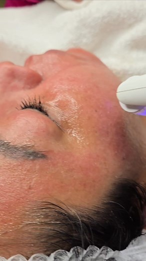 Microneedling roller, acompañado de un cóctel de serums de vitamina C,acido hialuronico, colageno,elastina,ampolleta super hidratante y otra regeneradora de piel. Entra más de 1mm dentro de la piel para una mayor efectividad 🩷 #annasmedandbeautyspa #medicaesthetician #monahanstx #odessatx #permianbasin #cranetx #Spa #midlandtx #spa #tramientosfaciales | Anna's med and beauty spa