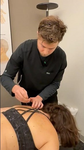 What Does Dry Needling Do to Your Nervous System?