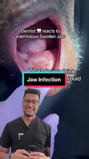 Abscessed Jaw: Causes, Symptoms, and Treatment Options