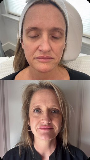 DEKA CO2 laser benefits: ✨Helps fine lines & wrinkles Boost collagen production Improves texture Brightens & tightens ✨ | MD Aesthetics of Mobile Bay