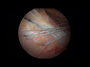 Endoscopic proximal hamstring repair