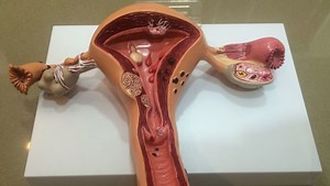 Barah ovari - apakah ia sebenarnya? Apa yang perlu anda tahu?