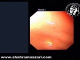Achalasia Endoscopy in Situs Inversus Totalis • Video • MEDtube.net
