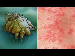 What is Scabies? Causes, Pictures Images Signs and Symptoms of Scabies