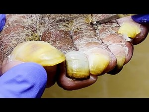 Especially long feet, the dead skin can be torn off the whole, too decompression!