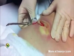 Draining A Monster Pimple