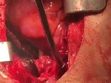 Repair of LT Pulmonary Artery with Patch in Order to Impede Pulmonary Artery Stenosis • Video • MEDtube.net