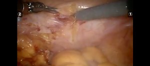 Robotic suprapubic simple prostatectomy: Step-by-step approach | Urology Times