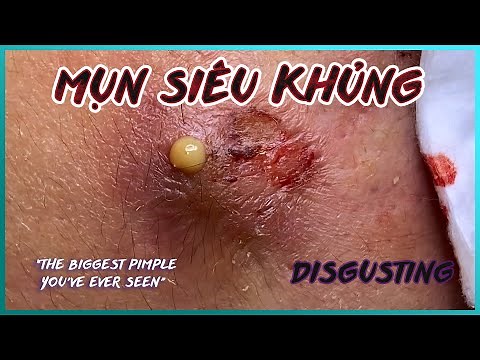 Big Cystic Acne Blackheads Extraction Blackheads & Milia, Whiteheads Removal Pimple Popping