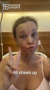 13K views · 640 reactions | 5 weeks and 9 weeek post op Deep Plane Face and Neck Lift. Just click the link in bio and let your transformation begin with Booking Surgery. Whataspp: https://wa.me/905396769475 #facelift #necklift #plasticsurgery #bookingsurgery | Booking Surgery | Facebook