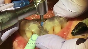 2.9K views · 32 reactions | Amazing implant of lower incisor ☺ Using Guided surgery. 3D peinters used to print A Stent. #Dentistry #The_Genius_Prof | The Genius Prof | Facebook