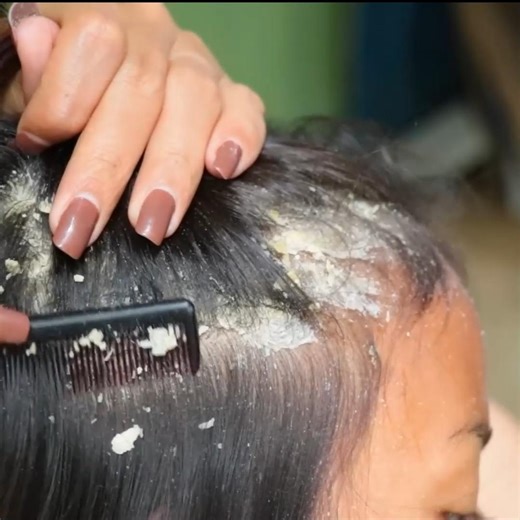 46K views · 77 reactions | Beautiful Girl Satisfying Biggest Dandruff #dandruffremoval #dandruffshampoo #dandruffproblems #dandrufftreatment | FreeQgame | Facebook