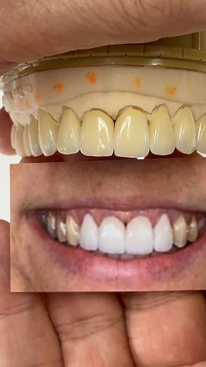 Recreating a smile! Case from Dr. Alexander Cox in New York! EnvisionTEC | Luke Kahng