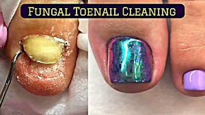 40K views | Thinergy: https://www.amazon.com/dp/B07HBDJD57/ Comedone Extractors with Gloves: https://www.amazon.com/dp/B071LGL345/ Gold Facial Mask: https://www.amazon.com/dp/B075G1YVYB/ Blackhead Facial Mask: https://amzn.to/2N21iJ4 | CystBursting.com | Facebook