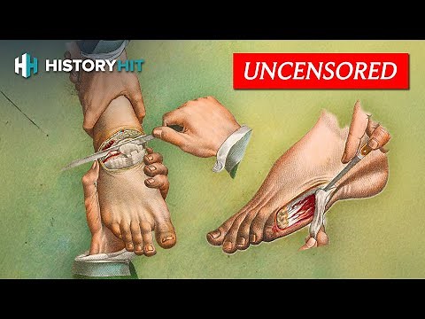 Medical History: Amputations In The Battlefield